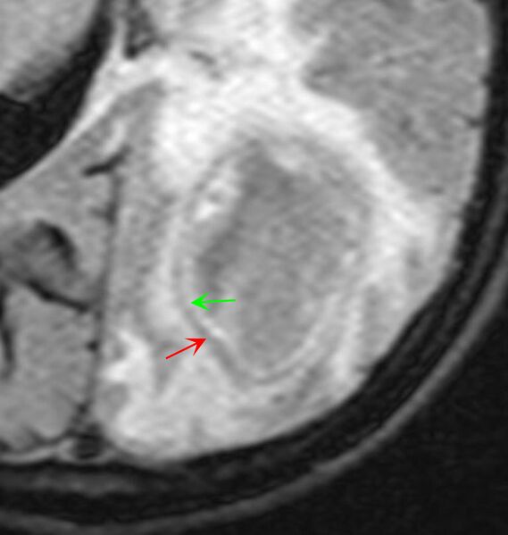 File:Brain abscess with dual rim sign (Radiopaedia 87566-103939 FLAIR 2).JPG