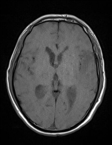 File:Brain abscess with ventriculitis (Radiopaedia 85703-101495 Axial T1 14).jpg