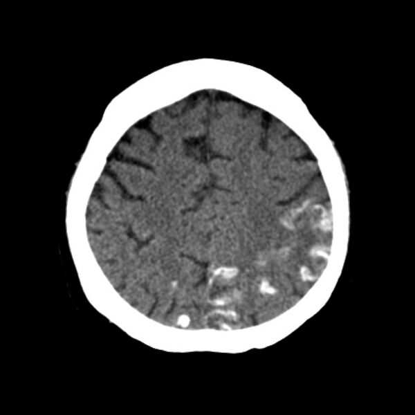 File:Brain cortical laminar necrosis (Radiopaedia 25822-25971 Axial non-contrast 34).jpg