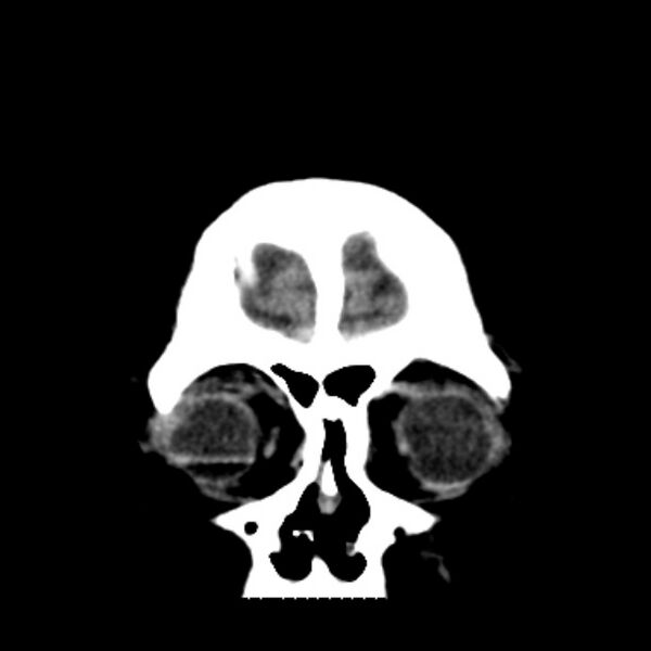 File:Brain cortical laminar necrosis (Radiopaedia 25822-25971 C 6).jpg