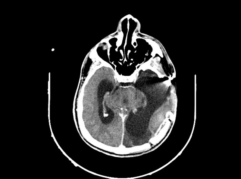 File:Brain injury by firearm projectile (Radiopaedia 82068-96088 B 114).jpg