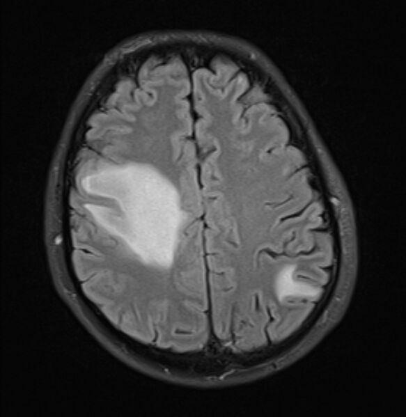 File:Brain metastases - lung cancer primary (Radiopaedia 75060-86115 Axial FLAIR 18).jpg
