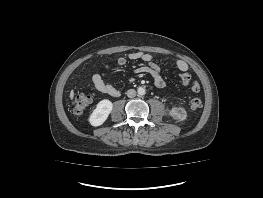 Brain metastases from renal cell carcinoma (Radiopaedia 42222-45328 B 154).jpg