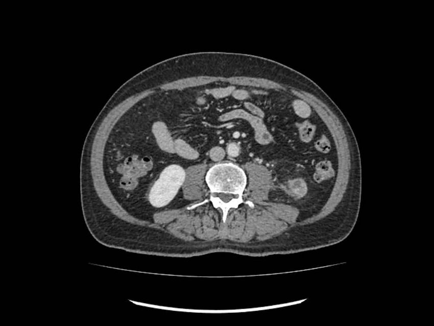 Brain metastases from renal cell carcinoma (Radiopaedia 42222-45328 B 156).jpg