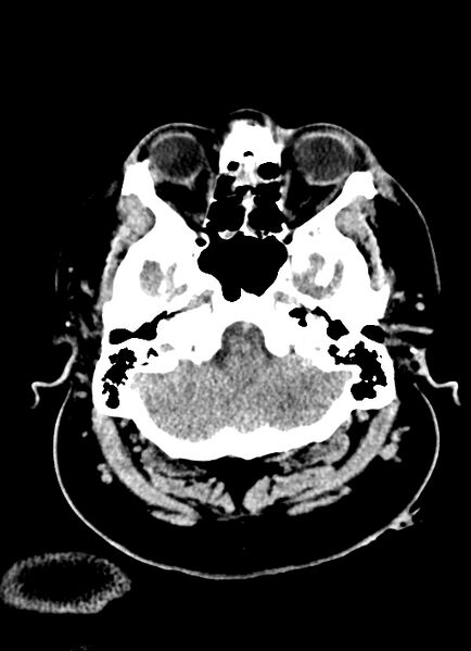 File:Brainstem hemorrhage (Radiopaedia 81294-94976 Axial non-contrast 51).jpg