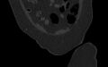 Breast carcinoma with pathological hip fracture (Radiopaedia 60314-67993 Coronal bone window 35).jpg