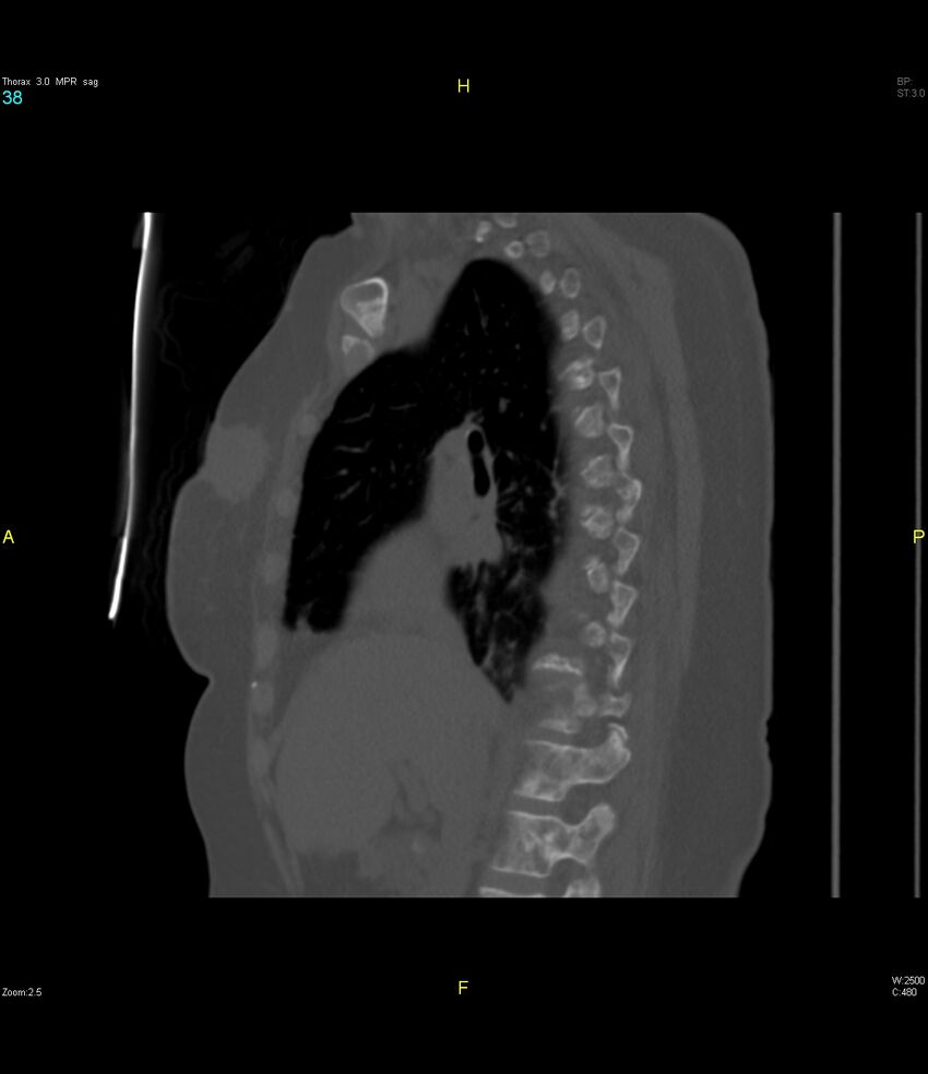 Breast primary with lung and bone metastases (Radiopaedia 40620-43228 Sagittal bone window 38).jpg