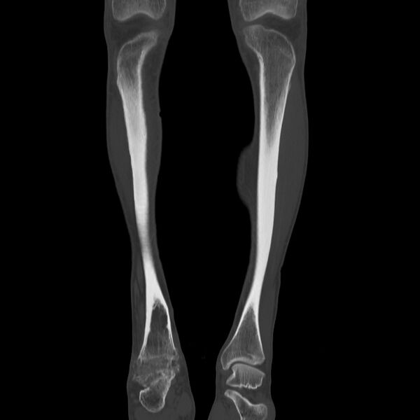 File:Brodie abscess - tibia (Radiopaedia 66028-75204 Coronal bone window 8).jpg