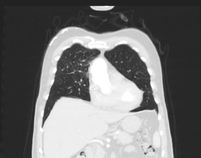 Bronchogenic carcinoma with lymphangitic spread (Radiopaedia 29002-29357 Coronal lung window 17).jpg