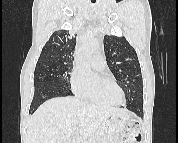 File:Bronchogenic carcinoma with superior vena cava syndrome (Radiopaedia 36497-38054 Coronal lung window 1).jpg