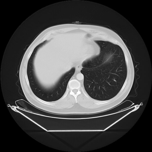 File:Bronchogenic carcinoma with upper lobe collapse (Radiopaedia 29297-29726 Axial lung window 27).jpg