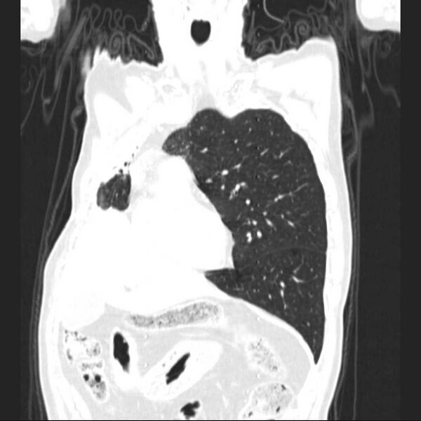 File:Bronchopleural fistula - postoperative complication (Radiopaedia 21020-20947 Coronal lung window 9).jpg