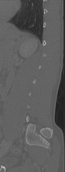 File:Burst fracture - T12 with conus compression (Radiopaedia 56825-63647 Sagittal bone window 18).png