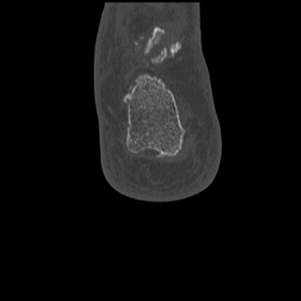 File:Calcaneal tuberosity avulsion fracture (Radiopaedia 22649-22668 Coronal bone window 63).jpg