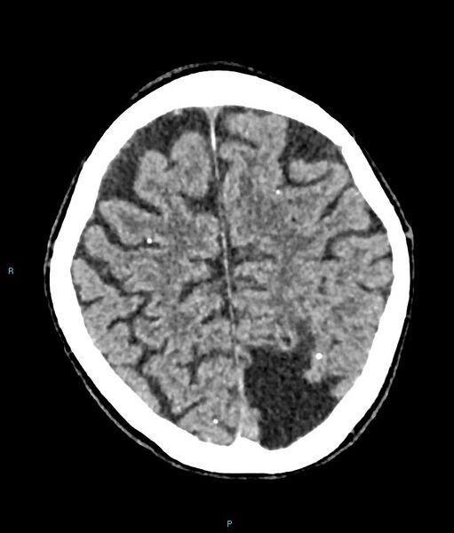 File:Calcified cerebral emboli from left ventricular thrombus (Radiopaedia 84420-99758 Axial non-contrast 26).jpg