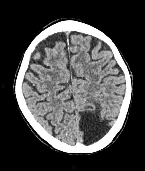 File:Calcified cerebral emboli from left ventricular thrombus (Radiopaedia 84420-99758 Axial non-contrast 28).jpg