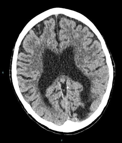 File:Calcified cerebral emboli from left ventricular thrombus (Radiopaedia 84420-99758 Axial non-contrast 41).jpg