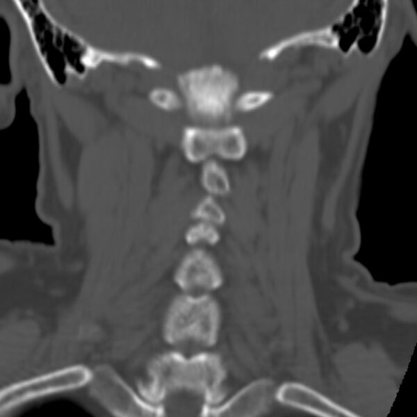 File:Calcified meningioma - cervical canal (Radiopaedia 70136-80171 Coronal bone window 25).jpg