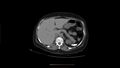 Calcified spleen (Radiopaedia 60952-68768 Axial non-contrast 6).jpg