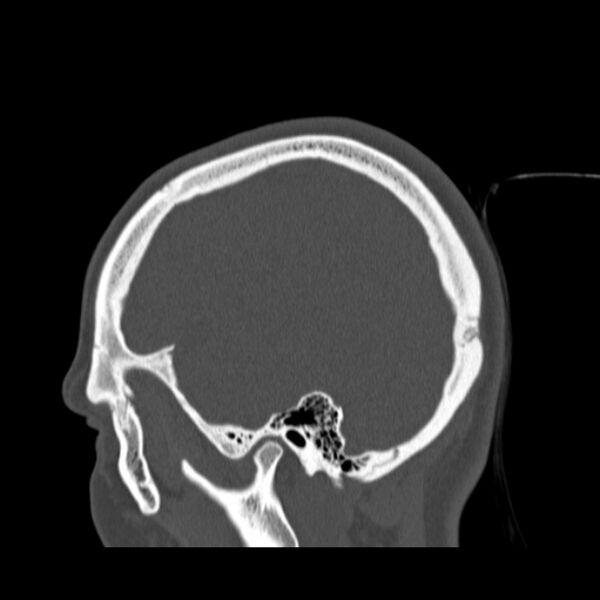 File:Calvarial osteoma (Radiopaedia 36520-38079 Sagittal bone window 24).jpg