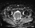 Cancer cervix - stage IIb (Radiopaedia 75411-86615 Axial ADC 11).jpg
