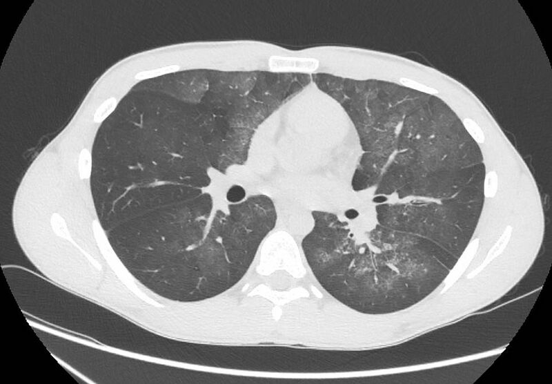 File:Cannabis-induced diffuse alveolar hemorrhage (Radiopaedia 89834-106946 Axial lung window 56).jpg