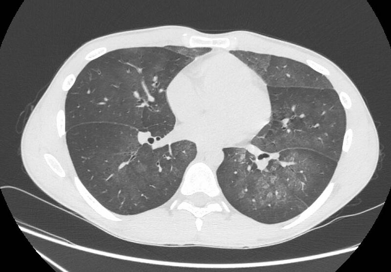 File:Cannabis-induced diffuse alveolar hemorrhage (Radiopaedia 89834-106946 Axial lung window 67).jpg