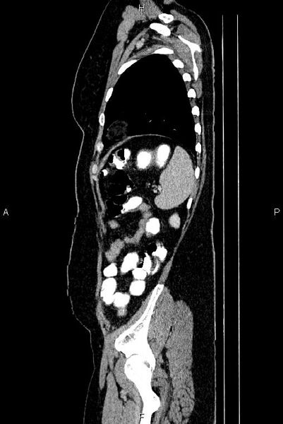 File:Carcinoma of uterine cervix (Radiopaedia 85861-101700 D 72).jpg