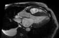 Cardiac amyloidosis (Radiopaedia 61600-69579 B 30).jpg