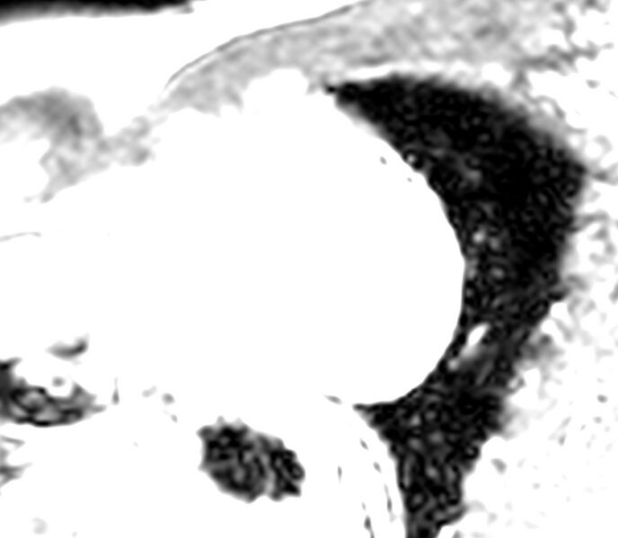 File:Cardiac sarcoidosis (Radiopaedia 39811-42243 LookLocker 16).jpg