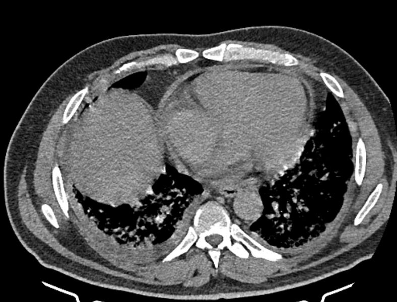 File:Cardiogenic pulmonary edema (Radiopaedia 68180-77678 Axial non-contrast 34).jpg