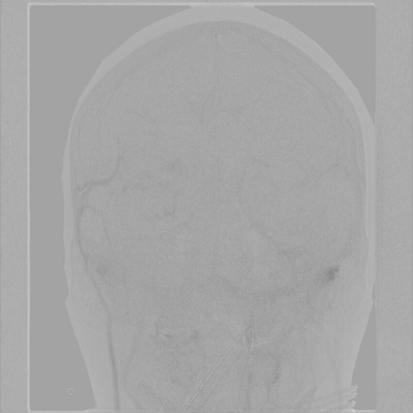Caroticocavernous fistula - direct (Radiopaedia 61660-69666 A 43).jpg