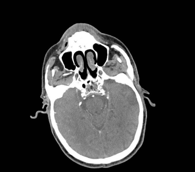 File:Carotid artery pseudoaneurysm (Radiopaedia 84030-99259 C 5).jpg