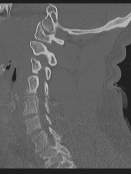 File:Cavernoma of cervical cord (Radiopaedia 50838-56346 Sagittal bone window 50).png