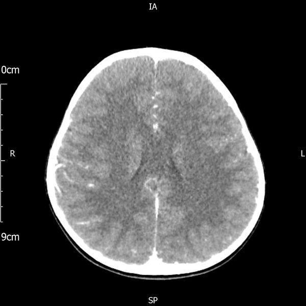 File:Cavernous sinus thrombosis (Radiopaedia 79414-92510 Axial Brain 124).jpg