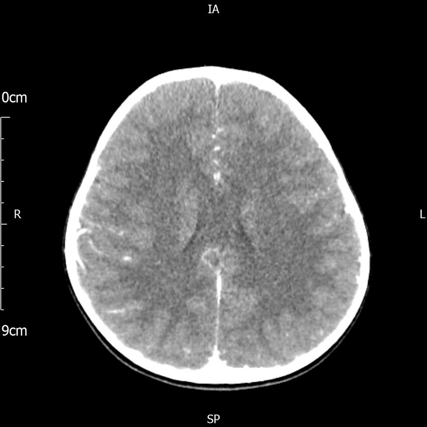Cavernous sinus thrombosis (Radiopaedia 79414-92510 Axial Brain 124).jpg