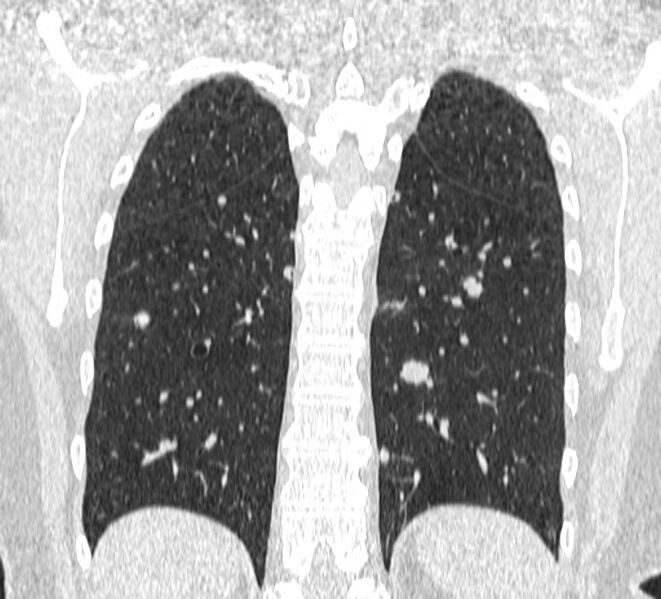 File:Cavitating pulmonary metastases (Radiopaedia 17796-17555 Coronal lung window 22).jpg