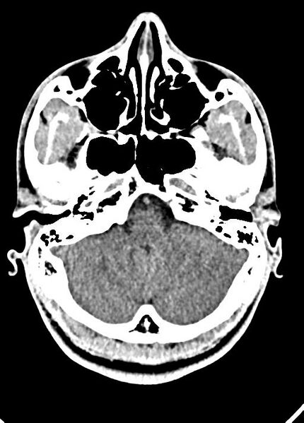 File:Cavum septum pellucidum and cavum vergae (Radiopaedia 77797-90060 Axial Brain Window 21).jpg