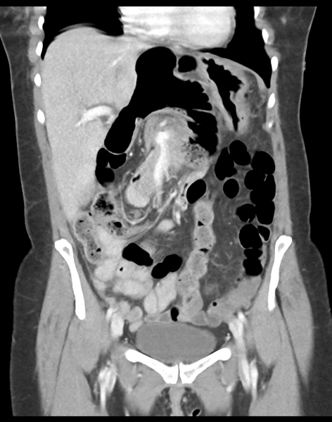 File:Cecum hernia through the foramen of Winslow (Radiopaedia 46634-51112 B 19).png