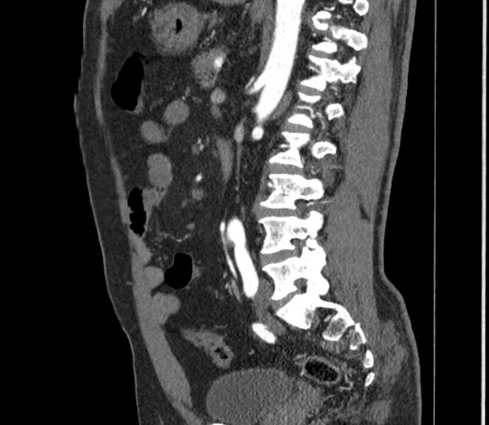 File:Celiac artery dissection (Radiopaedia 52194-58080 B 79).jpg