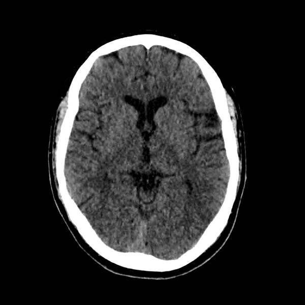 File:Central nervous system Langerhans cell histiocytosis (Radiopaedia 65728-74878 Axial non-contrast 26).jpg