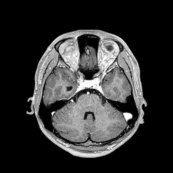 File:Central neurocytoma (Radiopaedia 79320-92380 Axial T1 C+ 86).jpg