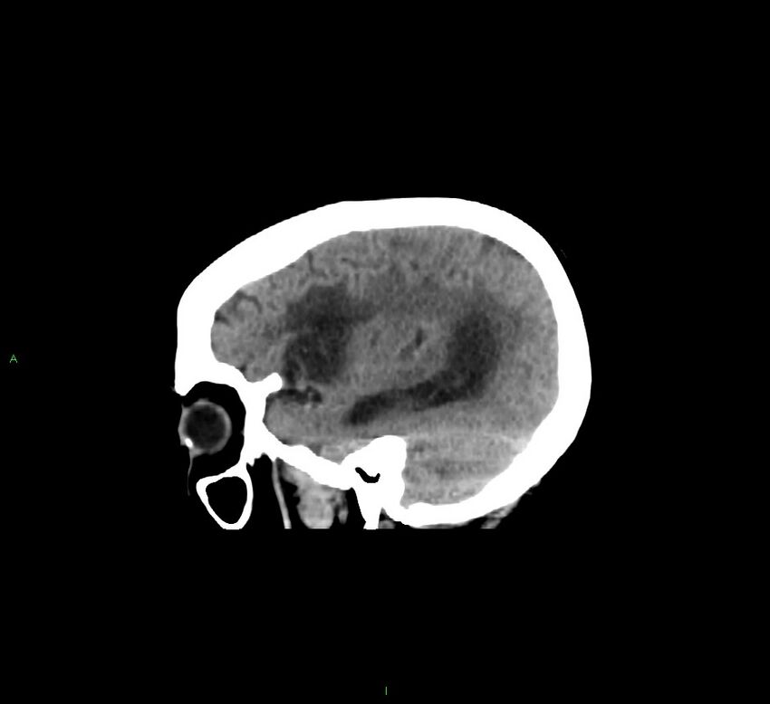 Cerebellar hemorrhage (Radiopaedia 58793-66027 C 15).jpg