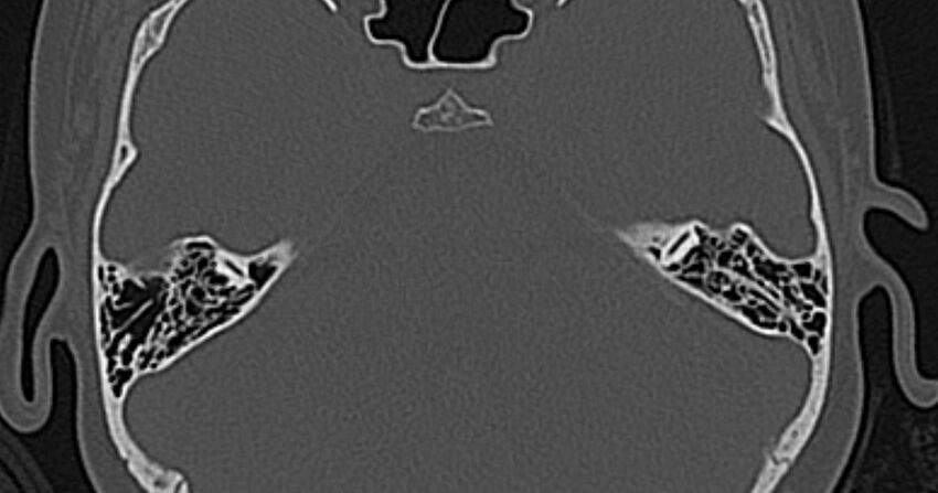 Cerebellopontine angle lipoma (Radiopaedia 57303-64242 Axial bone window 45).jpg