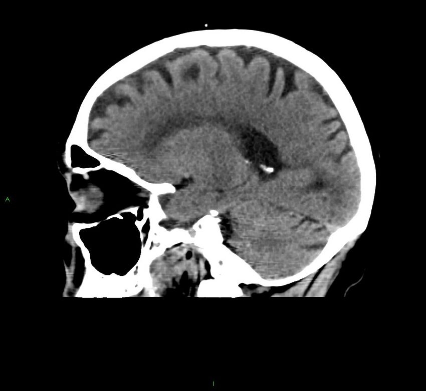 Cerebral amyloid angiopathy-associated lobar intracerebral hemorrhage (Radiopaedia 58376-65511 C 20).jpg