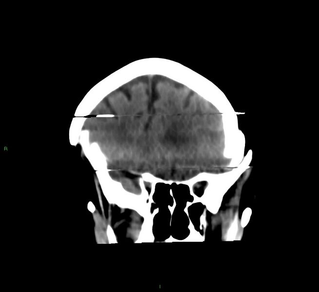 File:Cerebral amyloid angiopathy-associated lobar intracerebral hemorrhage (Radiopaedia 58377-65514 Coronal non-contrast 47).jpg