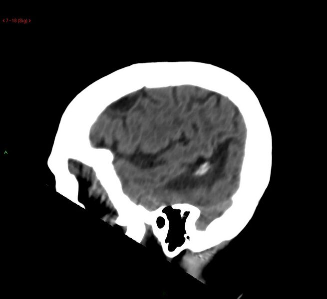 File:Cerebral amyloid angiopathy-associated lobar intracerebral hemorrhage (Radiopaedia 58378-65518 C 18).jpg