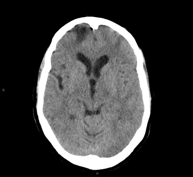 File:Cerebral amyloid angiopathy-associated lobar intracerebral hemorrhage (Radiopaedia 58529-65686 Axial non-contrast 11).jpg