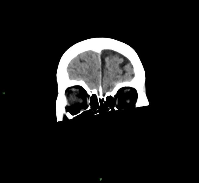 File:Cerebral amyloid angiopathy-associated lobar intracerebral hemorrhage (Radiopaedia 58563-65727 Coronal non-contrast 54).jpg
