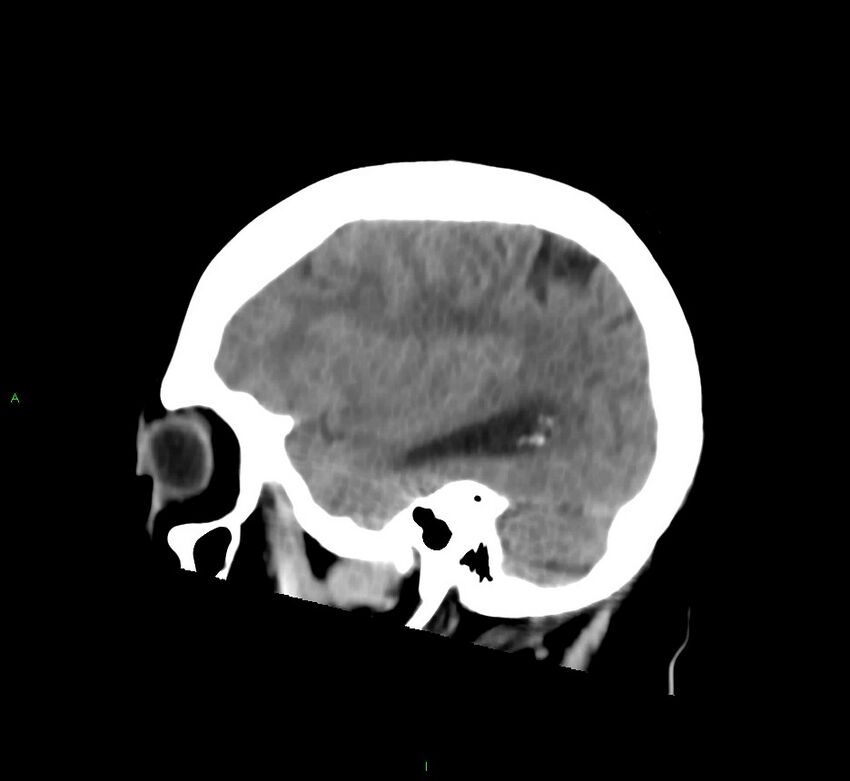 Cerebral amyloid angiopathy-associated lobar intracerebral hemorrhage (Radiopaedia 58752-65973 C 15).jpg